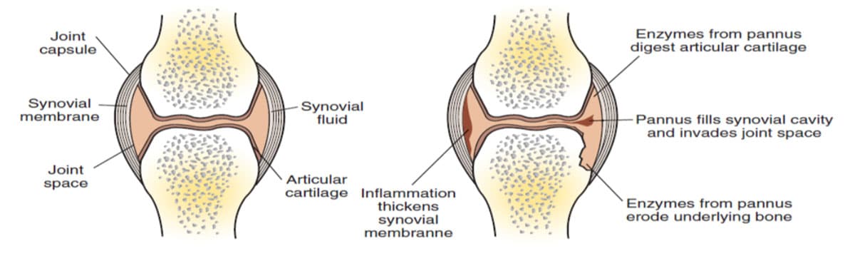 Rheumatoid Arthritis; From Etiology to Nutritional Therapy