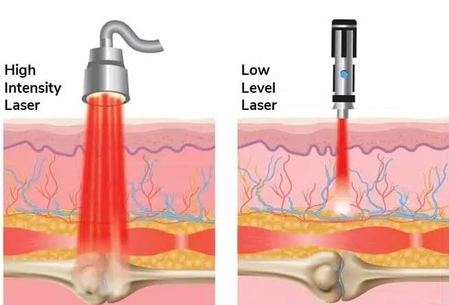Biological effects of laser therapy