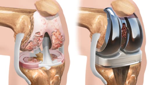 Reemplazo de la articulación de la rodilla o artroplastia