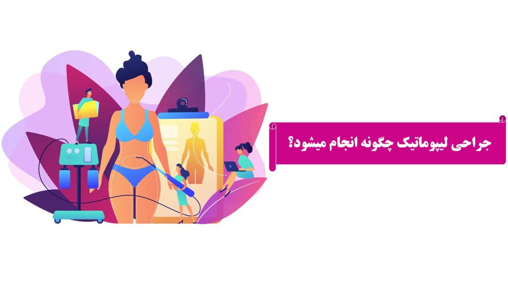 Liposuction ameliyatı nasıl yapılır?