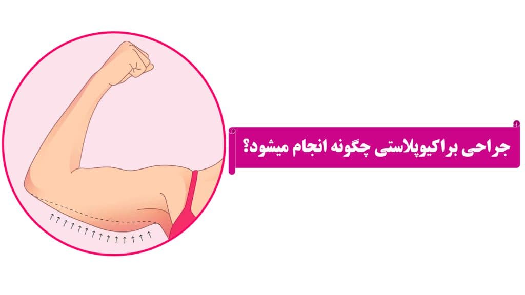 Brachioplasty ameliyatı nasıl yapılır?